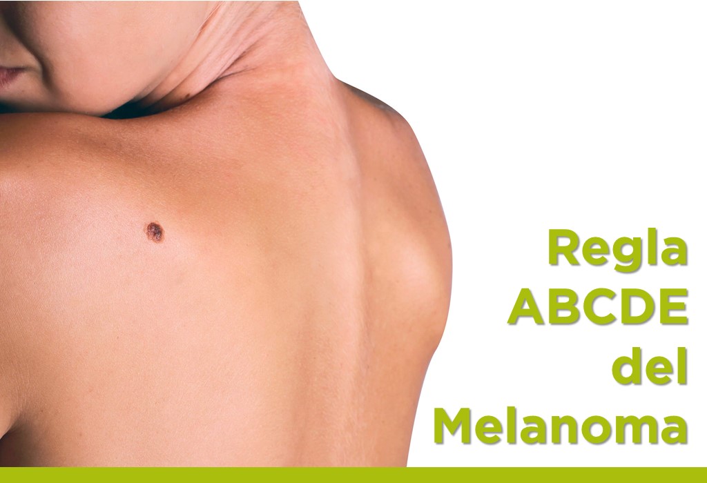 Regla ABCDE del Melanoma