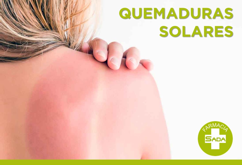 Quemaduras Solares