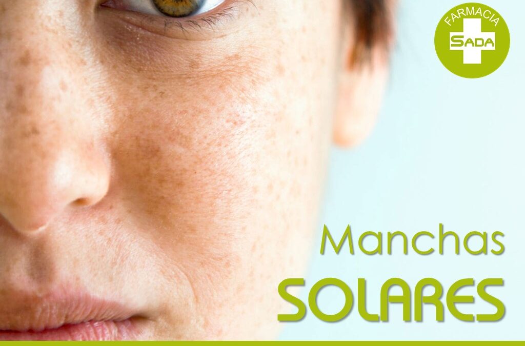 Manchas solares: por qué aparecen y cómo prevenirlas antes del verano