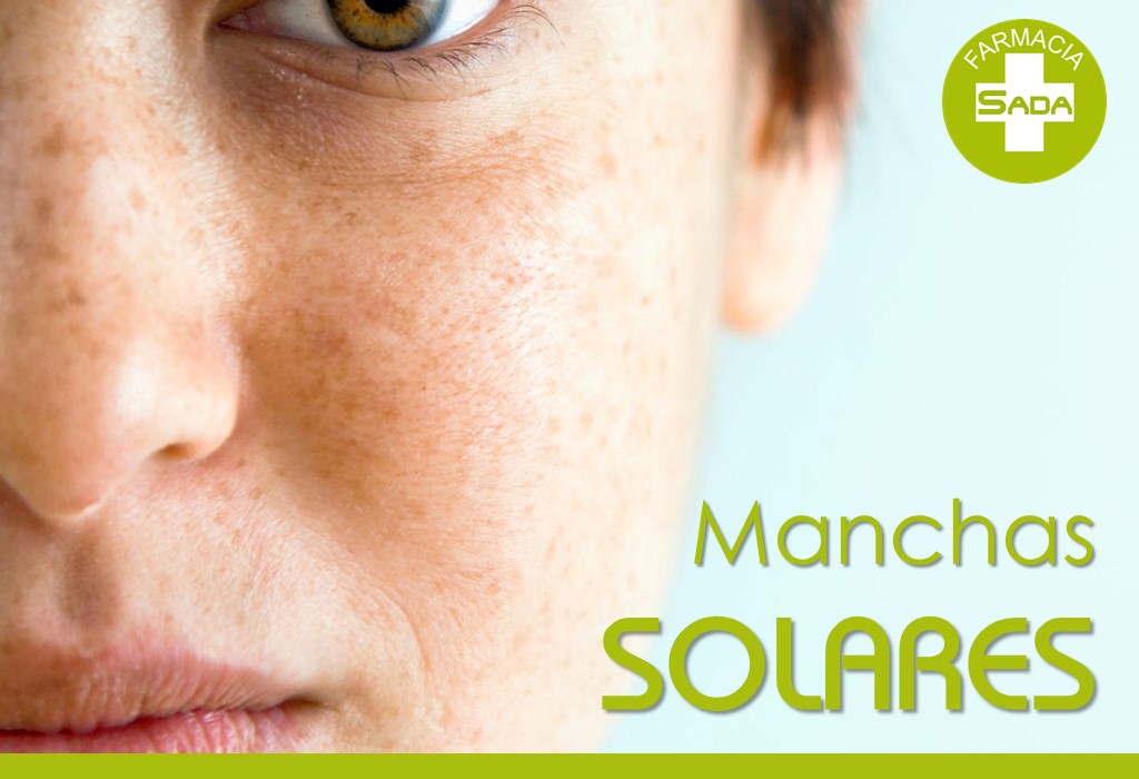 Manchas solares: por qué aparecen y cómo prevenirlas antes del verano