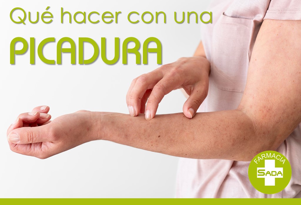 ¿Qué hacer ante una picadura de medusa, mosquito o avispa?